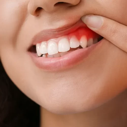 Invisalign For Teens - Straightening Smiles For Adolescents